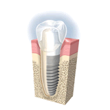 インプラント治療のイメージ